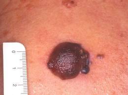 Scoperto un pigmento che potrebbe aiutare a sconfiggere il melanoma
