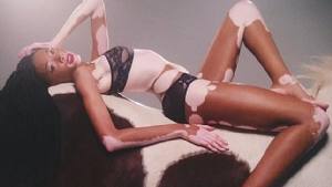 Winnie Harlow, prima modella con la vitiligine: «A scuola mi chiamavano Zebra»