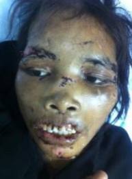 Ad una ragazza indonesiana:labbra tagliate con le forbici e schiena bruciata con il ferro da stiro